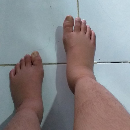 kaki bengkak