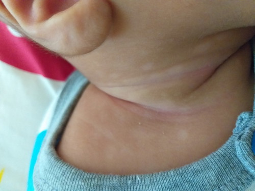 putih2 dan lecet dbgian leher bayi