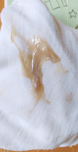 mucus plug