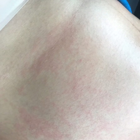 ท้อง27W3D มีผื่นคันขึ้น