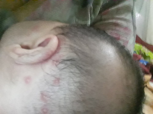 bintik merah dan lecet di belakang kuping