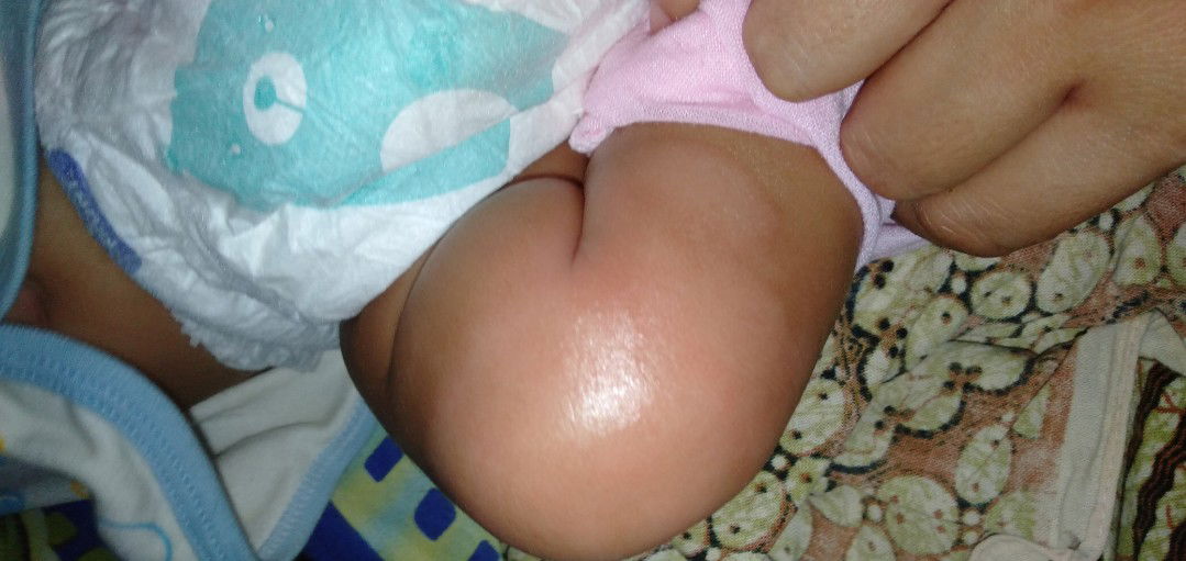 gatal pada kulit bayi