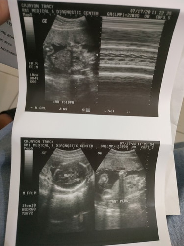 Ultrasound