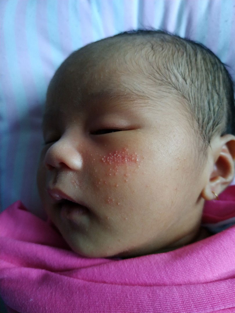 Bintik pada Wajah Bayi