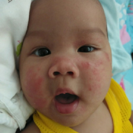 หน้าเป็นผื่น