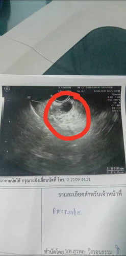 ท้องไม่ท้อง