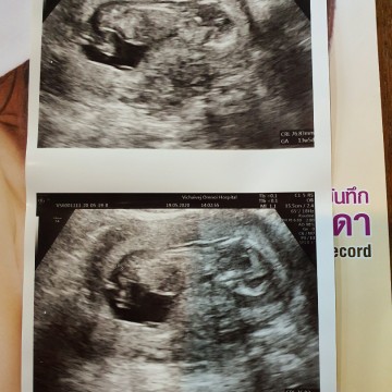 13 วีค 5วัน น้ำหนักไม่ขึ้นเลยค่ะ ลดอีกต่างหาก
