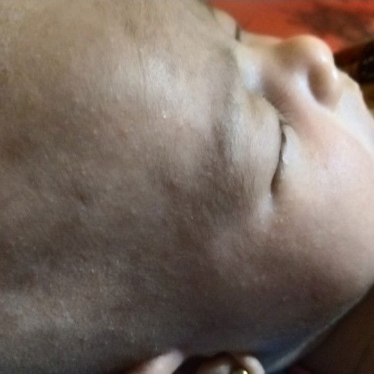 obat bruntusan pada bayi 23 hari