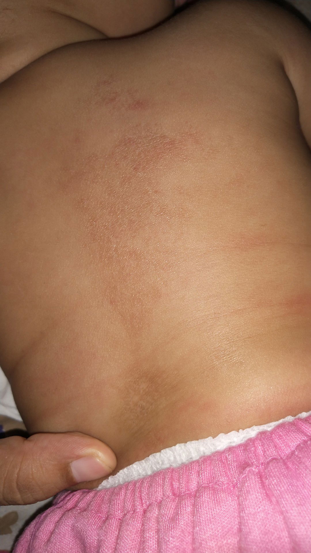 KULIT BAYI KU KENAPA YA?