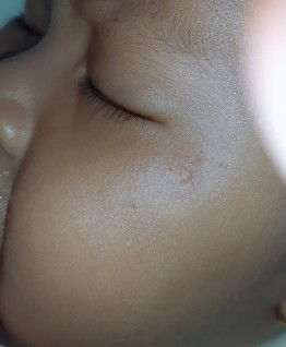 bintik merah kecil di muka