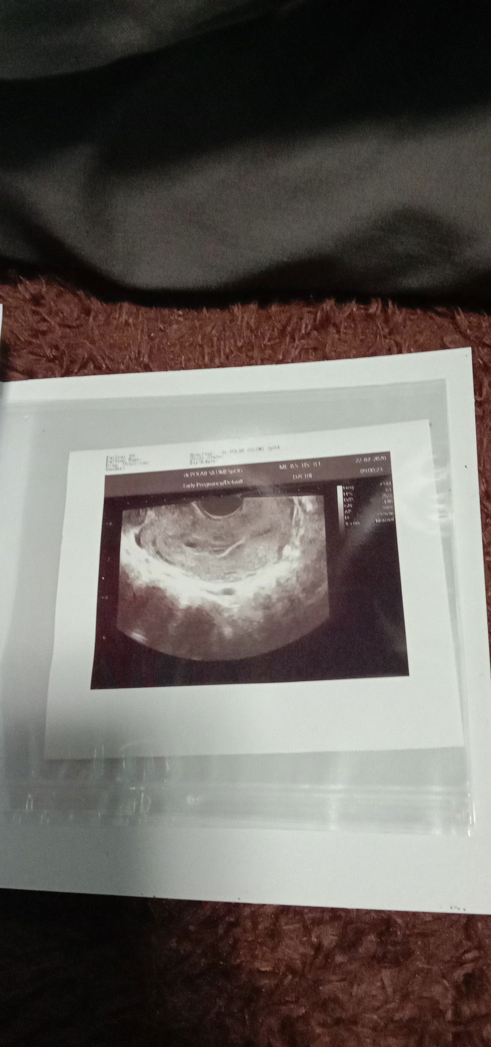 hamil dluar kandungan😱bahayakah itu???