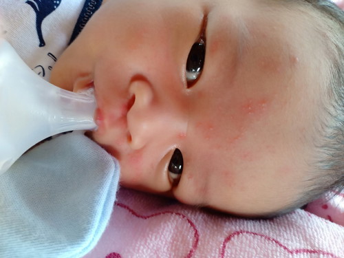 ผดแดงบนหน้าทารก