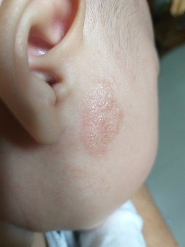 ผิวหนังเป็นแบบนี้ต้องรักษายังไงครับ