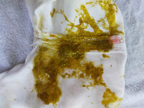 ขี้แบบนี้ปกติไหมคะ ลูกขี้วันละ 3-5/วัน ค่ะ