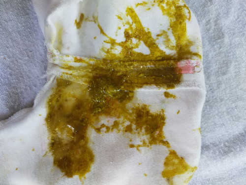 ขี้แบบนี้ปกติไหมคะ น้องขี้วันละ 3-5