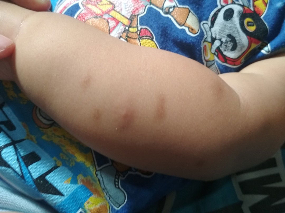 bekas gigitan nyamuk