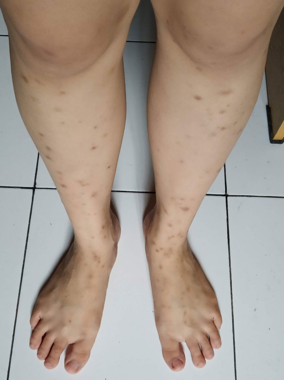 bekas gigitan nyamuk