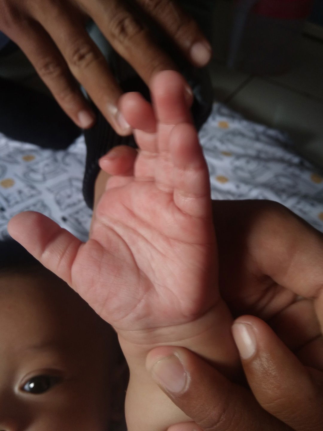 telapak tangan dan kaki bintik bintik