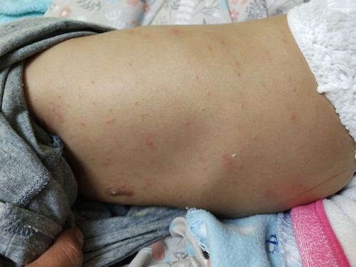 น้องอายุ9เดือน. เป็นตุ้มคันไม่หาย