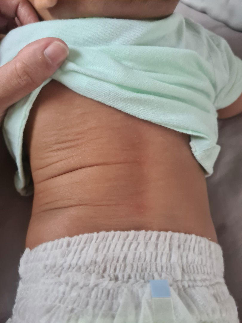 นัง PM ตัวดีย์ : ลูกวัย 5 เดือนผื่นขึ้นหลัง แขน ขา พื้นที่ใต้ผ้าอ้อม