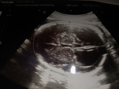 ลูกน้ำในสมองไม่เท่ากัน