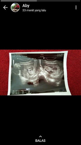 saya mau tanya kenapa bayi saya masih terlentang padahal dokter mengajurkan untuk sujud setia hari