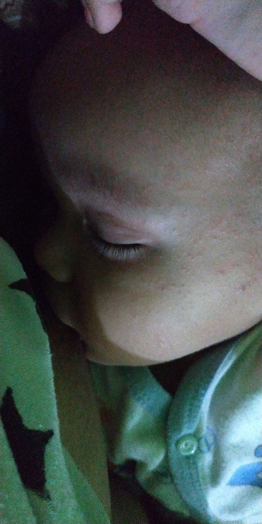 bruntusan dan gatal
