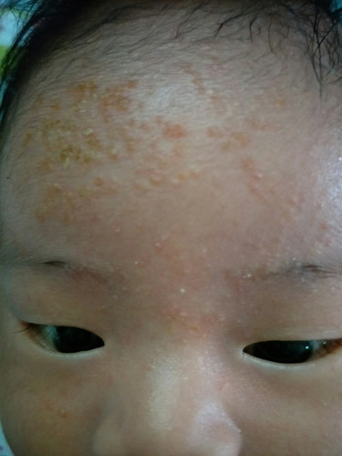 ตุ่มแดงขึ้นหน้าผาก