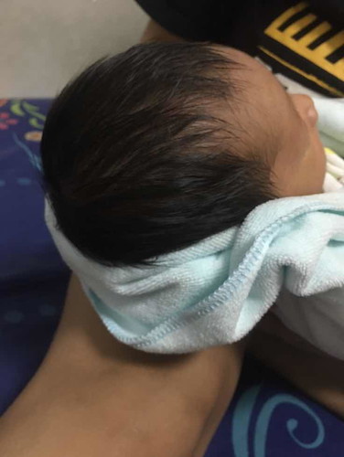 ลูกหัวโนหลังคลอด