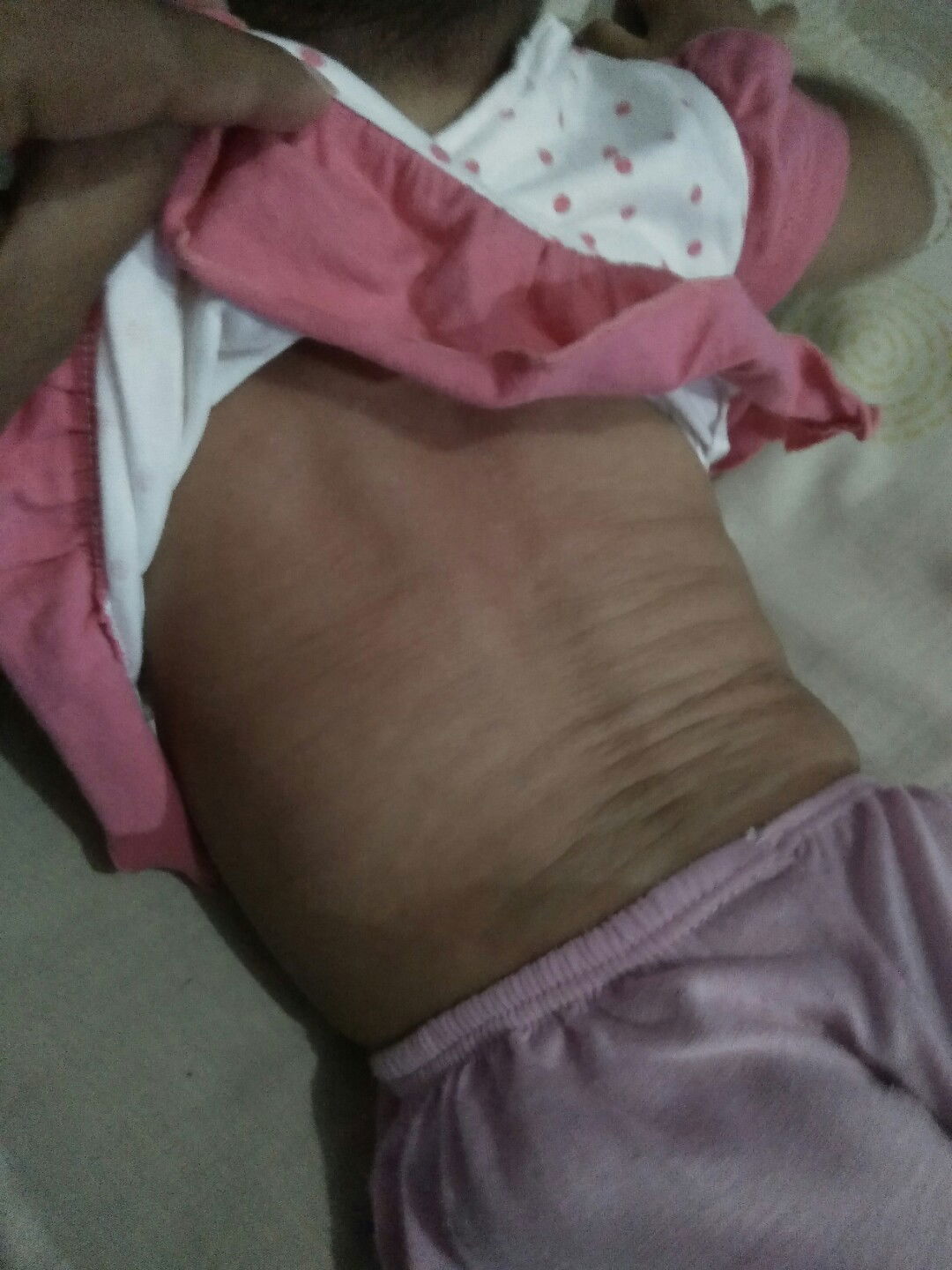 Bantu jawab bunsay.... Ruam kulit pasca demam turun