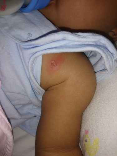 เป็นแผลแดงๆ