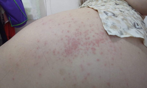 Pregnancy Rashes