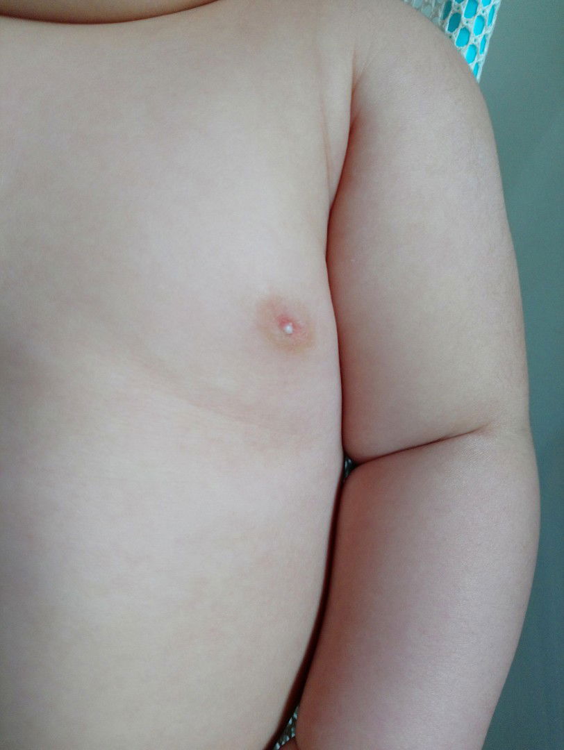 ตุ่มสีขาวที่หัวนมลูกคืออะไรคะ