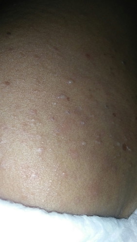 kulit bayiku bruntusan berair