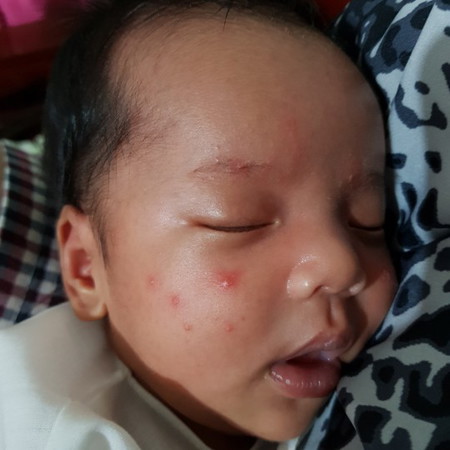 สอยถามเรื่องผื่น/ผด