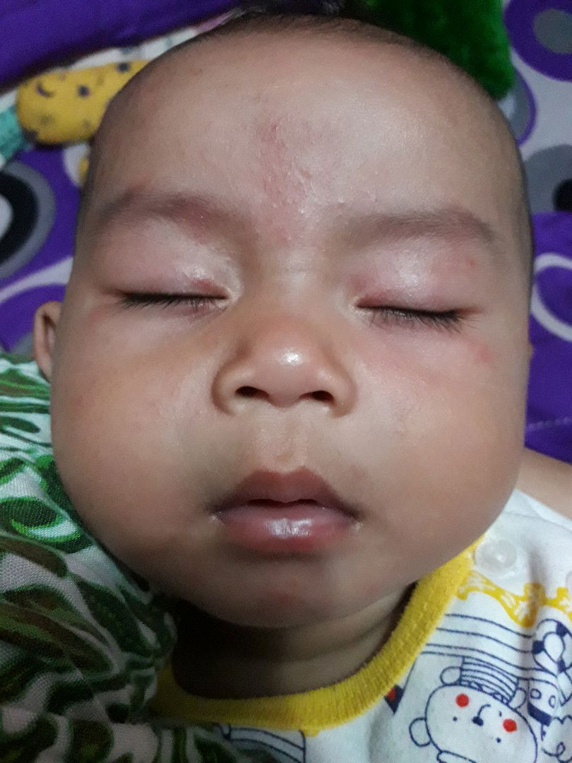 Muka bayi bruntusan dan merah