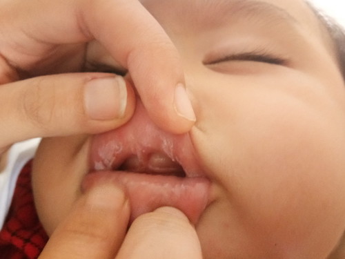 Oral Thrush / jamur mulut