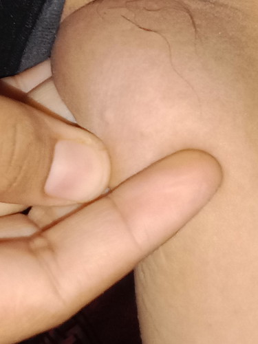 Benjolan kecil di lengan dekat ketiak seperti jerawat