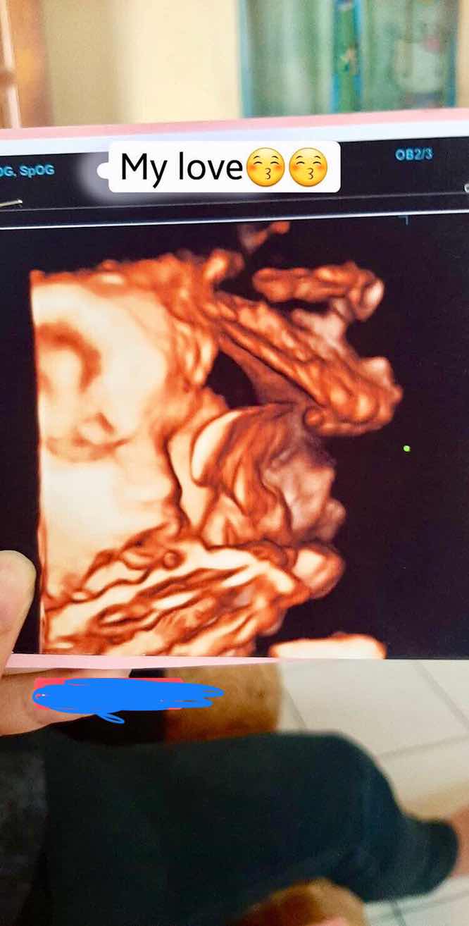 Hpl di kedua dokter berbeda