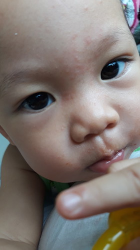ผื่นบนหน้า