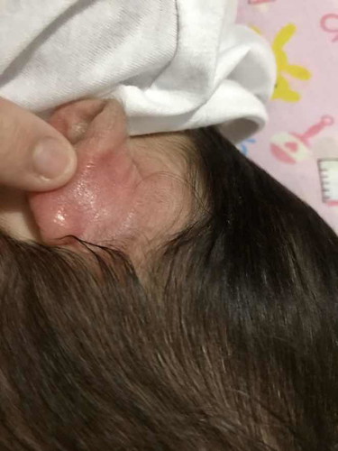 Cradle cap