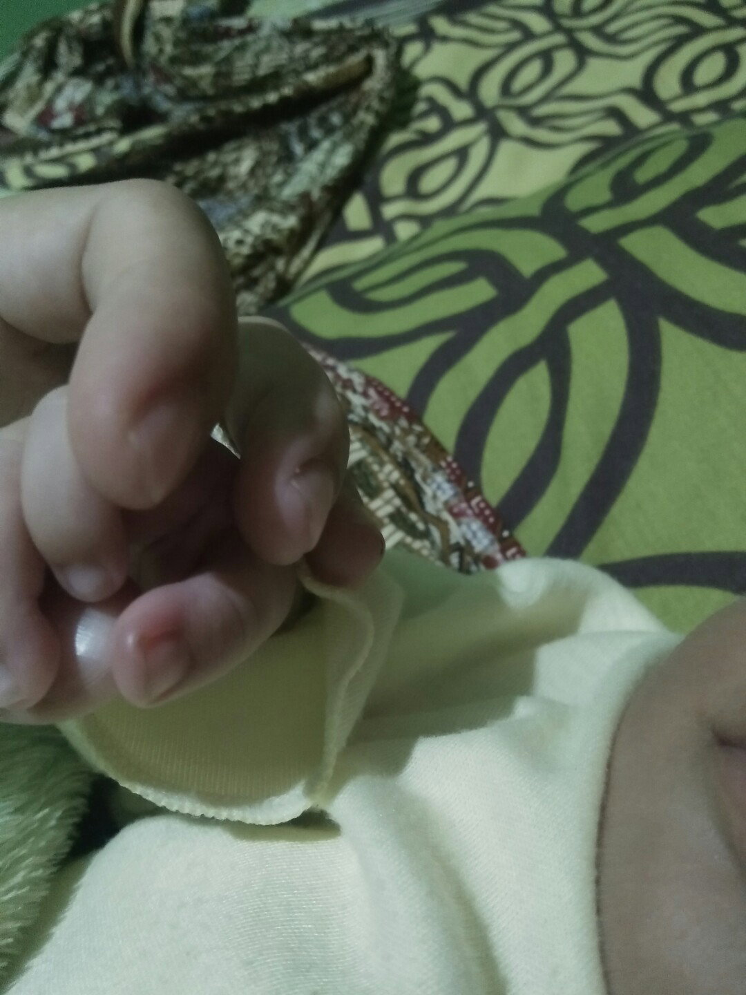 kuku bayi bengkak