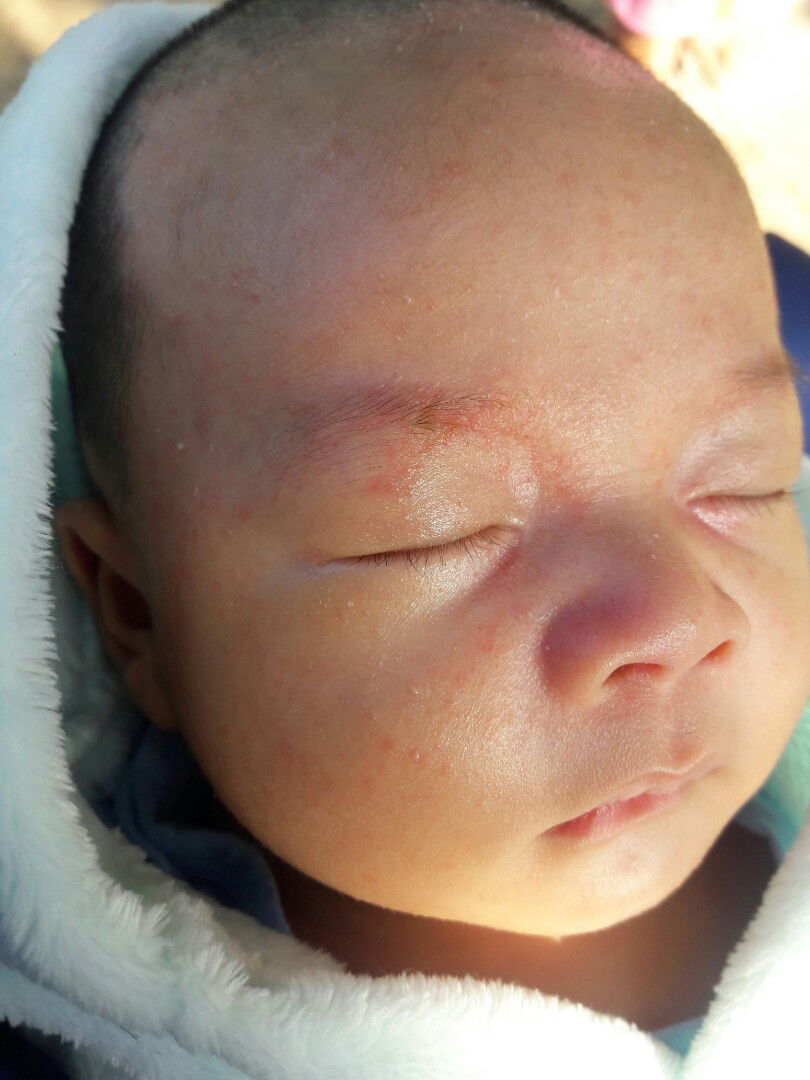 bintik2 merah di wajah