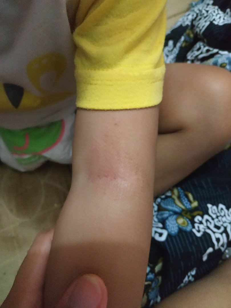 tangan anak gatal