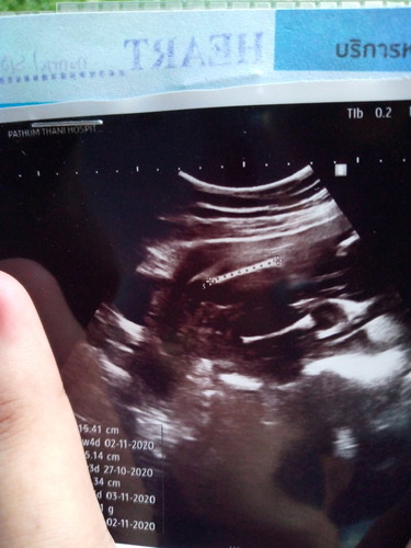 อัลตร้าซาวด์