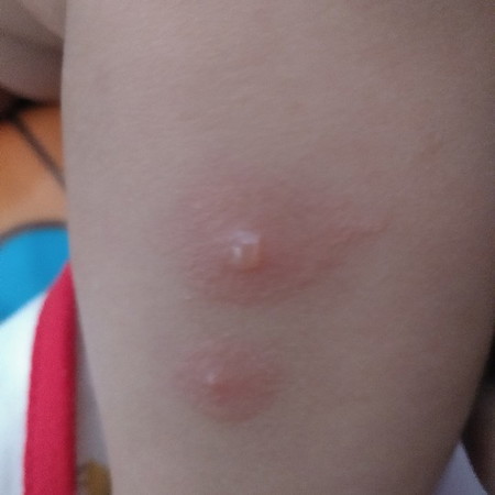 ตุ่มยุง