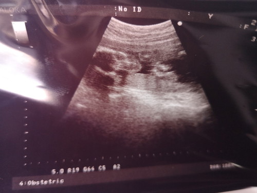 แม่ๆช่วยดูผลอันตร้าซาวด์หน่อยค่ะ