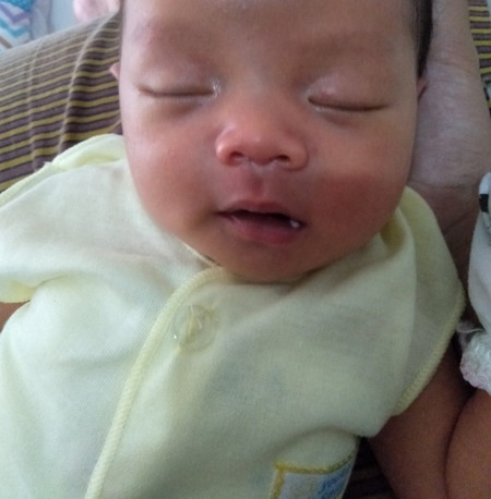 bibir bayi kya sariawan