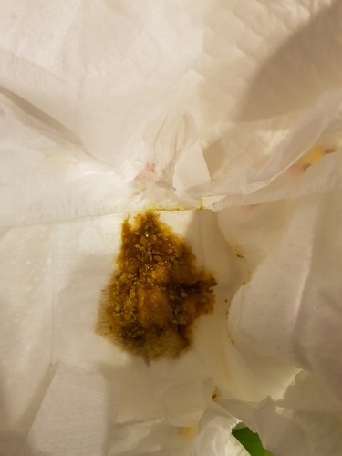 อุจจาระของลูกเป็นแบบนี้ ผิดปกติไหมคะ