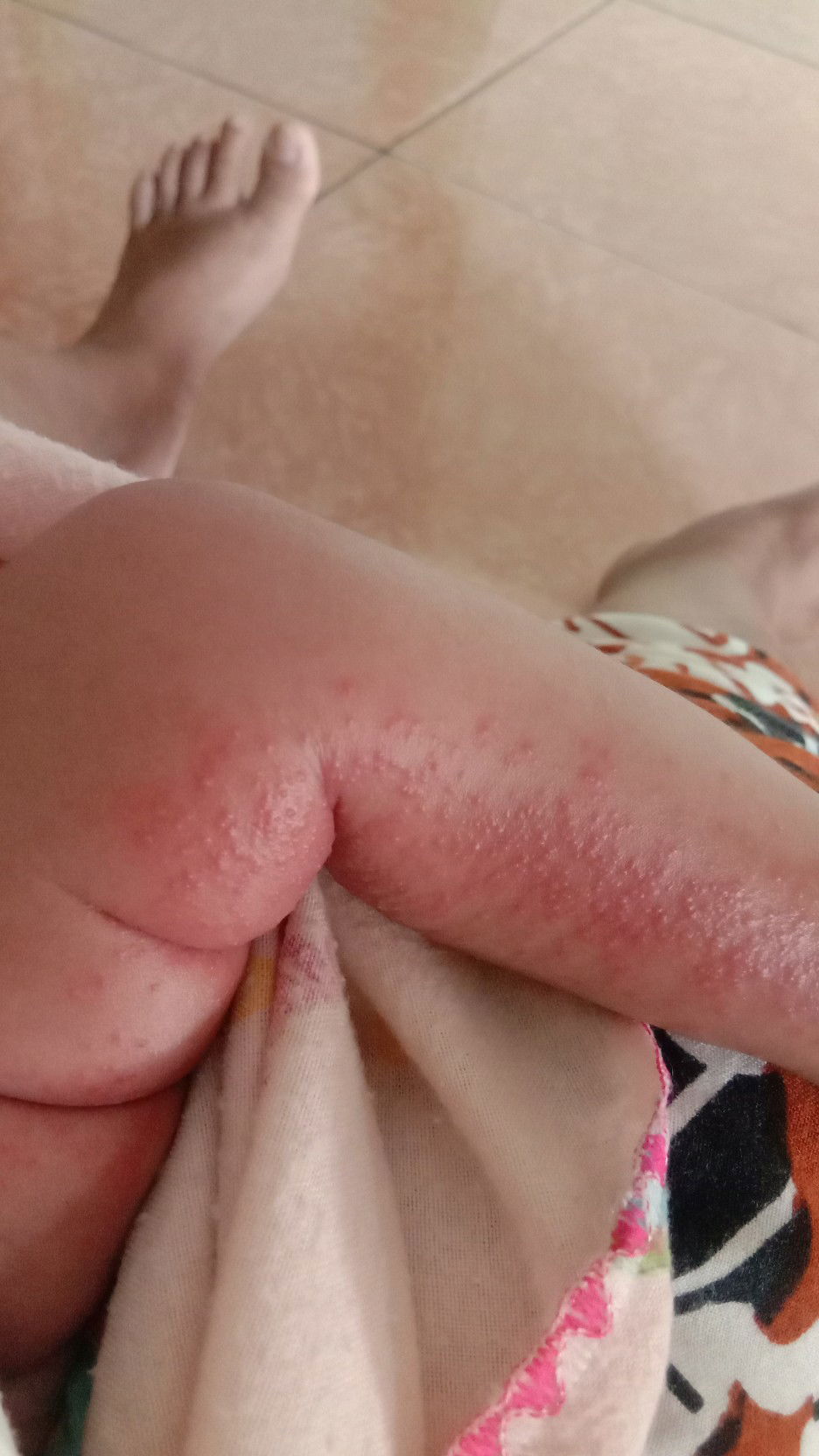 Ruam diseluruh tubuh